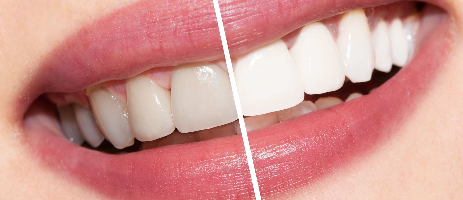 Clareamento dental Sorriso Já Bauru