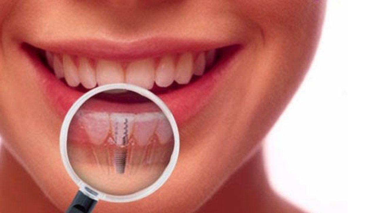 Implantes dentários Sorriso Já Bauru São Paulo